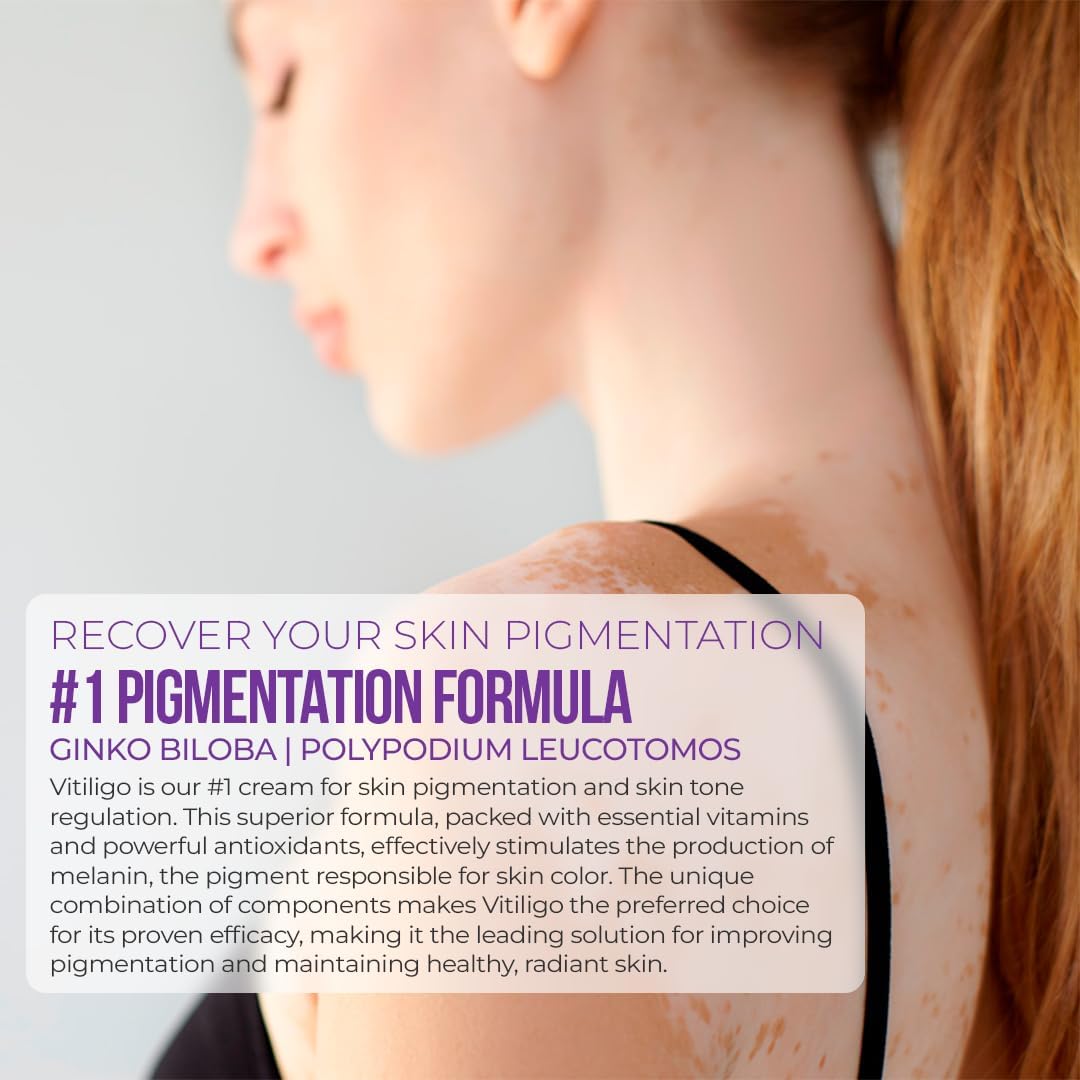 Vitiligo