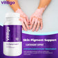 Vitiligo