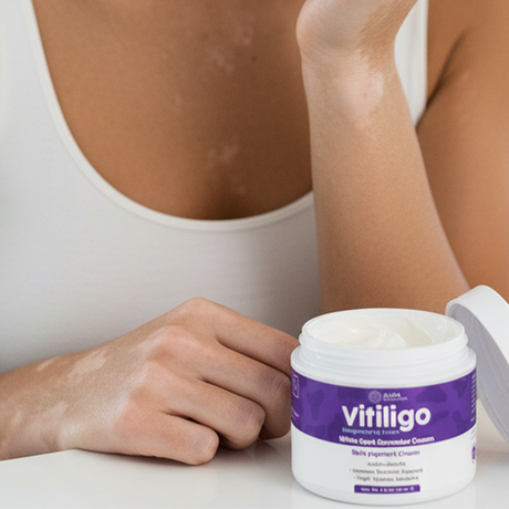 Vitiligo Cream - Pigmentation cream open jar
